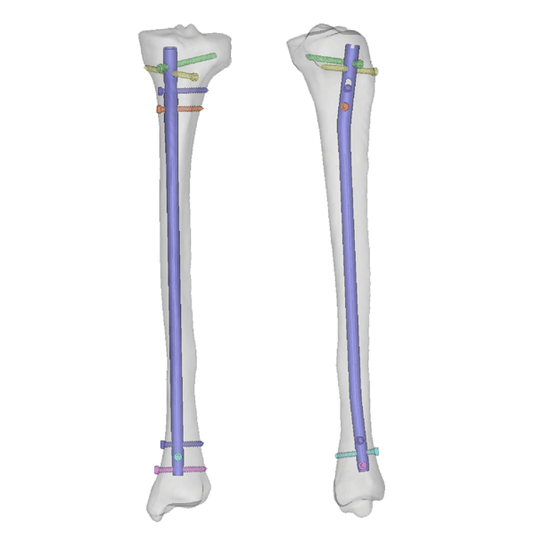 tibialni-cavao-2
